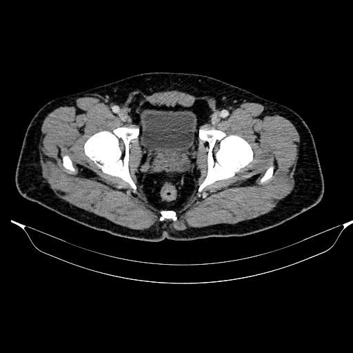 Acute pancreatitis (Radiopaedia 87428-103757 Axial C+ portal venous phase 92).jpg