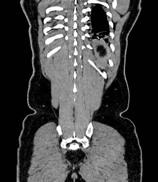 Acute pancreatitis (Radiopaedia 87428-103757 Coronal C+ portal venous phase 82).jpg