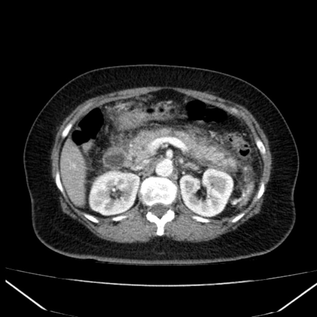 Acute pancreatitis - Balthazar C (Radiopaedia 26569-26714 Axial C+ arterial phase 32).jpg