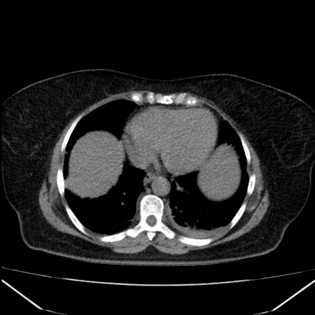 Acute pancreatitis - Balthazar C (Radiopaedia 26569-26714 Axial non-contrast 11).jpg
