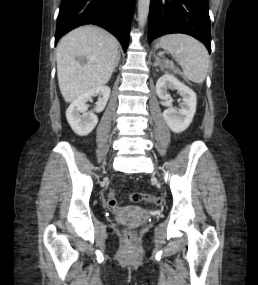 Acute pancreatitis - Balthazar E - post ERCP (Radiopaedia 27562-27772 Coronal C+ portal venous phase 57).png