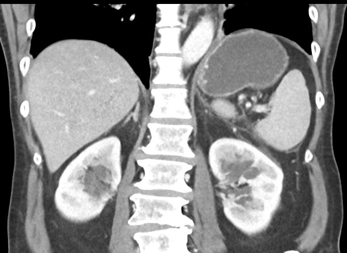 Acute pancreatitis and walled-off necrosis (Radiopaedia 29888-30404 Coronal C+ portal venous phase 36).jpg