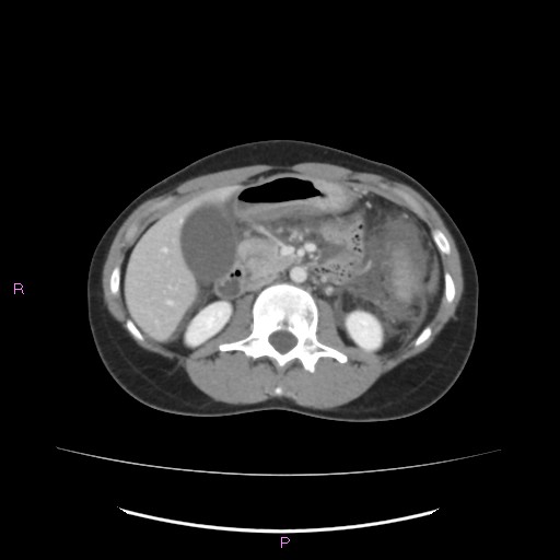 Acute pancreatitis secondary to stone at minor papilla and pancreatic divisum (Radiopaedia 76570-88333 Axial C+ portal venous phase 33).jpg