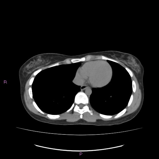 Acute pancreatitis secondary to stone at minor papilla and pancreatic divisum (Radiopaedia 76570-88333 Axial non-contrast 3).jpg