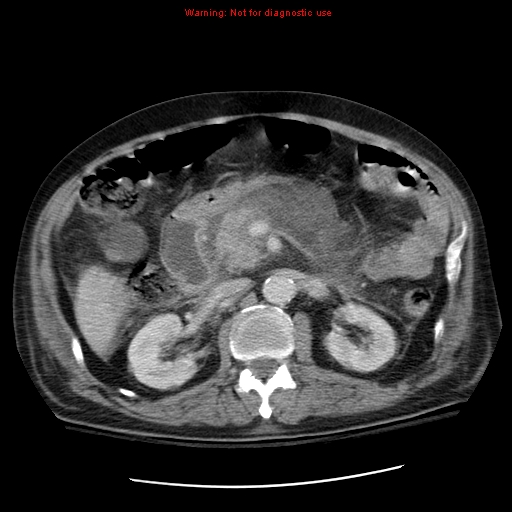 File:Acute pancreatitis with incidental pancreatic lipoma (Radiopaedia 10190-10730 Axial C+ portal venous phase 29).jpg
