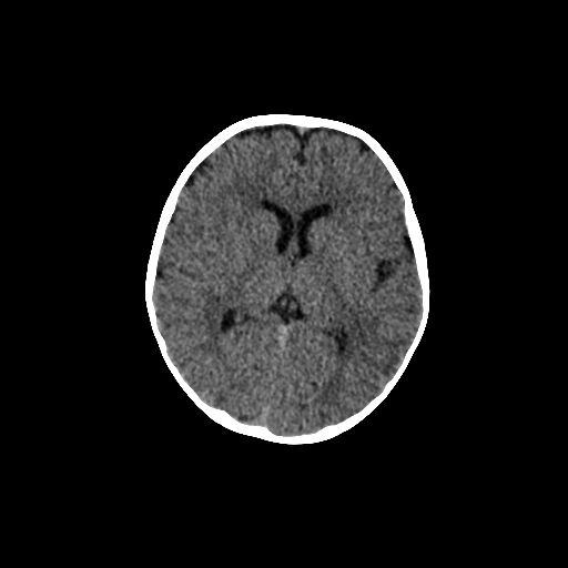 File:Acute phase of hemiconvulsion-hemiplegia epilepsy syndrome (Radiopaedia 29309-29744 Axial non-contrast 25).jpg