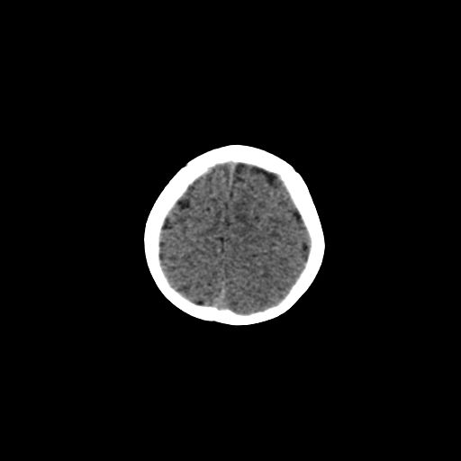 Acute phase of hemiconvulsion-hemiplegia epilepsy syndrome (Radiopaedia 29309-29744 Axial non-contrast 8).jpg