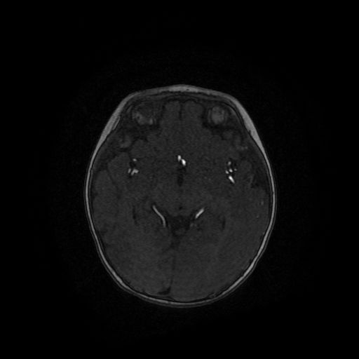 File:Acute phase of hemiconvulsion-hemiplegia epilepsy syndrome (Radiopaedia 29309-29745 Axial TOF angiography 68).jpg