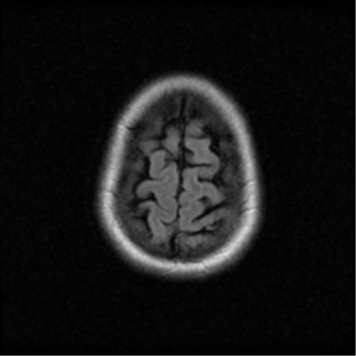 File:Acute pontine infarct from vertebral artery dissection (Radiopaedia 34111-35370 Axial FLAIR 20).png