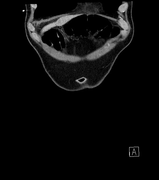 Acute renal infarction (Radiopaedia 59375-66736 Coronal C+ portal venous phase 9).jpg