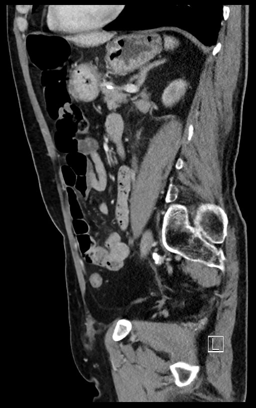 Acute renal infarction (Radiopaedia 59375-66736 Sagittal C+ portal venous phase 22).jpg