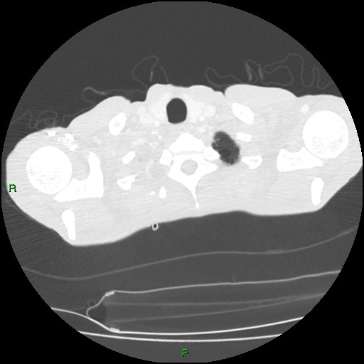 File:Acute right lung abscess (Radiopaedia 34806-36258 Axial lung window 6).jpg