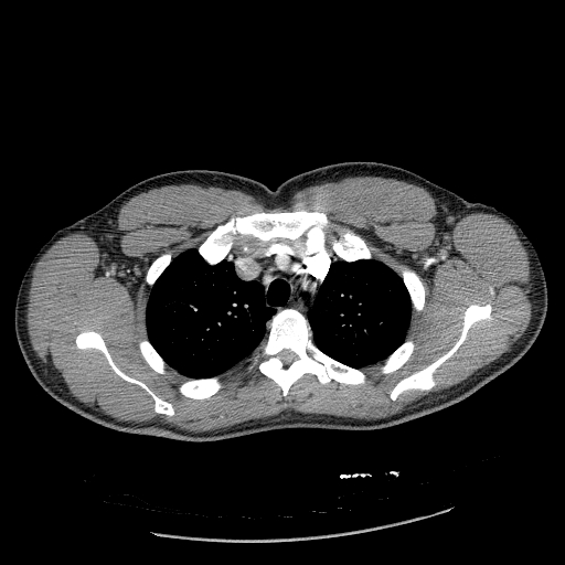 Acute segmental pulmonary emboli and pulmonary infarction (Radiopaedia 62264-70444 Axial C+ CTPA 30).jpg