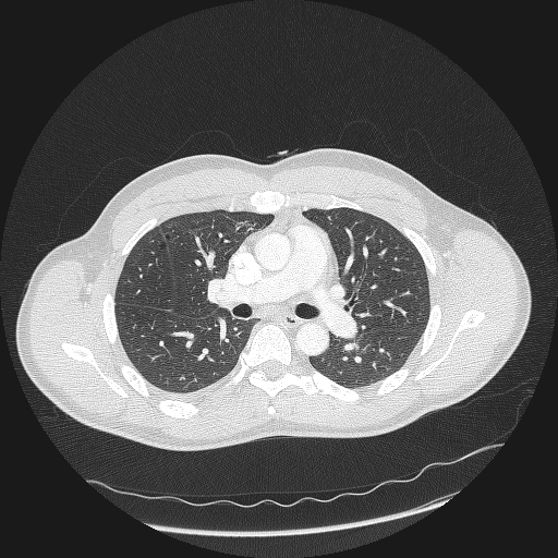 Acute segmental pulmonary emboli and pulmonary infarction (Radiopaedia 62264-70444 Axial lung window 76).jpg