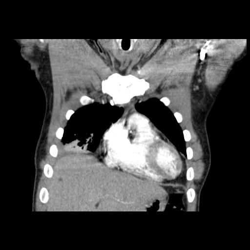 Acute segmental pulmonary emboli and pulmonary infarction (Radiopaedia 62264-70444 Coronal C+ CTPA 7).jpg