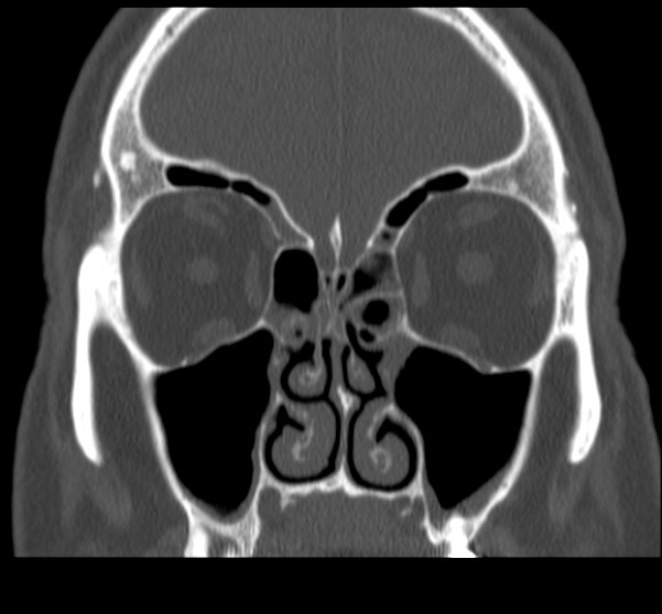 Acute sinusitis (Radiopaedia 23161-23215 Coronal bone window 33).jpg