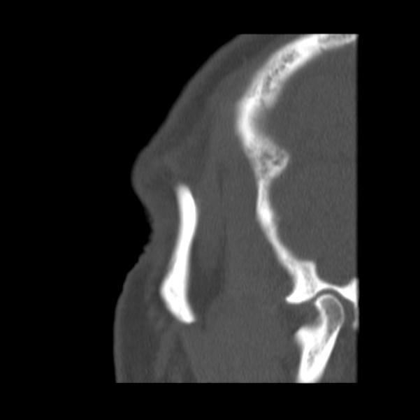 Acute sinusitis (Radiopaedia 23161-23215 Sagittal bone window 59).jpg