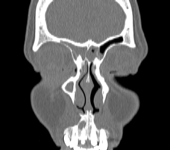 Acute sinusitis (Radiopaedia 40564-43158 Coronal bone window 5).jpg