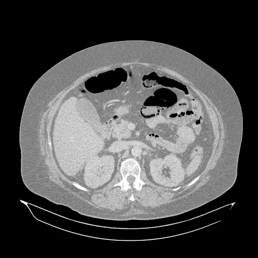 Acute superior mesenteric artery occlusion (Radiopaedia 51288-56960 Axial lung window 16).jpg