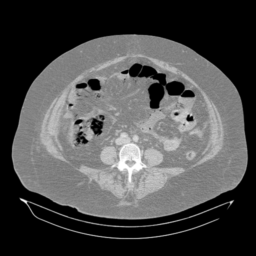 Acute superior mesenteric artery occlusion (Radiopaedia 51288-56960 Axial lung window 40).jpg