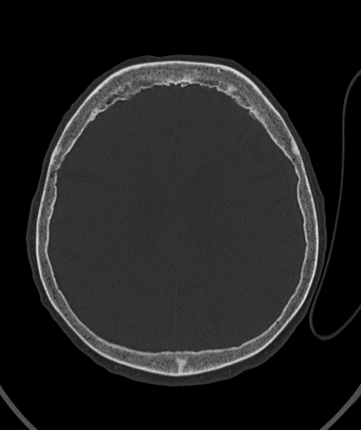 Acute traumatic subdural hematoma (Radiopaedia 82921-97257 Axial bone window 41).jpg