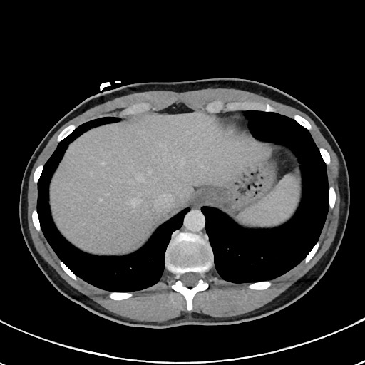 File:Acute uncomplicated appendicitis (Radiopaedia 61374-69304 Axial C+ portal venous phase 14).jpg