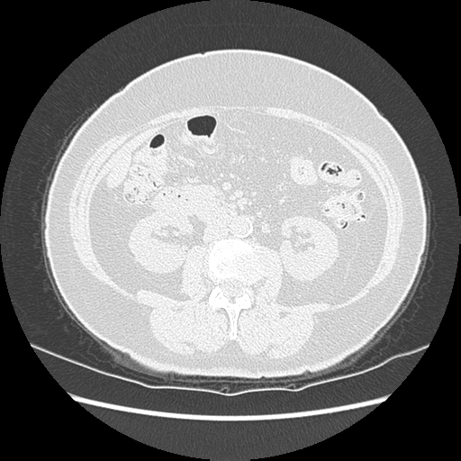 Adenocarcinoma in situ of lung (Radiopaedia 38685-40829 B 274).png