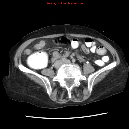 File:Adenocarcinoma of the colon (Radiopaedia 8191-9039 Axial renal excretory phase 34).jpg