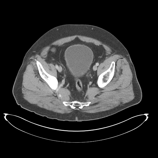 File:Adenocarcioma of rectum- T1 lesion (Radiopaedia 36921-38547 Axial C+ portal venous phase 75).png