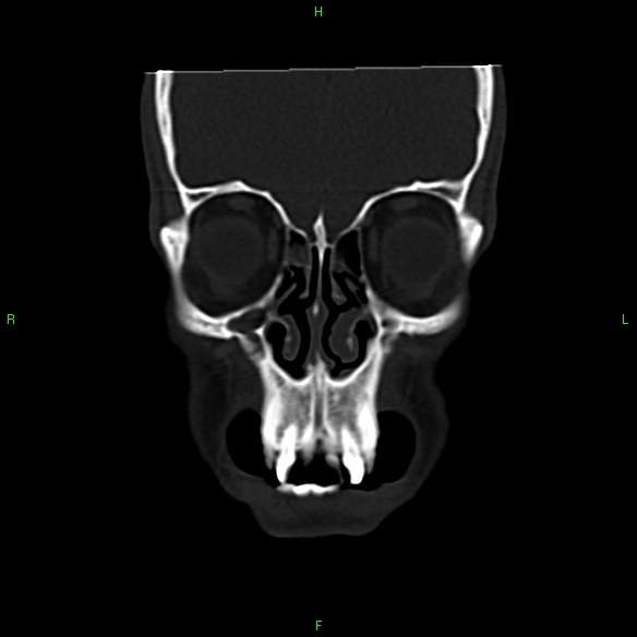 File:Adenoid cystic carcinoma of hard palate (Radiopaedia 26137-26273 Coronal bone window 5).jpg