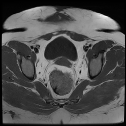 File:Adenomyosis within a didelphys uterus (Radiopaedia 70175-80215 Axial T1 28).jpg