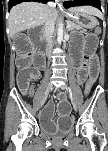 Adhesional small bowel obstruction (Radiopaedia 48397-53305 Coronal C+ portal venous phase 185).jpg