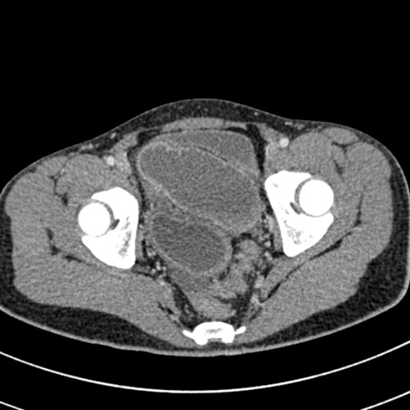 Adhesional small bowel obstruction (Radiopaedia 52107-57980 Axial C+ portal venous phase 116).jpg