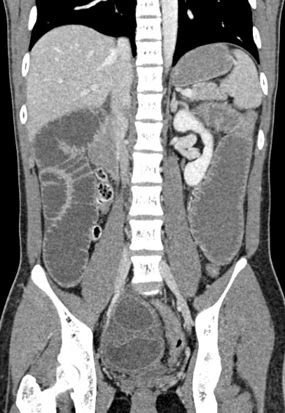 Adhesional small bowel obstruction (Radiopaedia 52107-57980 Coronal C+ portal venous phase 49).jpg