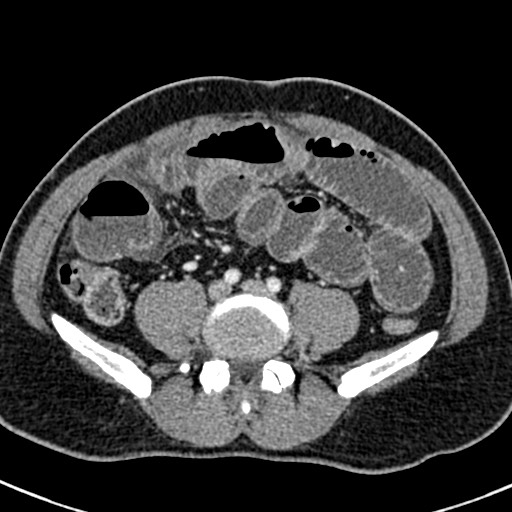 Adhesional small bowel obstruction (Radiopaedia 58900-66131 Axial C+ portal venous phase 34).jpg