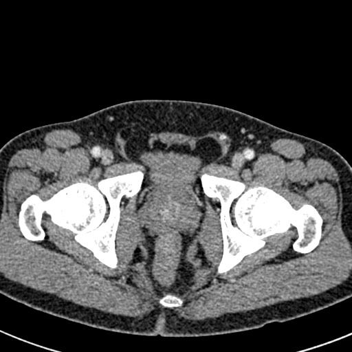 File:Adhesional small bowel obstruction (Radiopaedia 58900-66131 Axial C+ portal venous phase 52).jpg