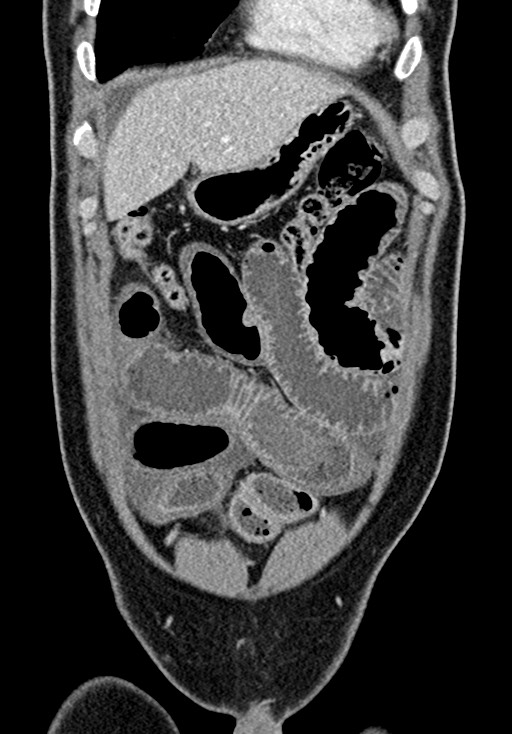 Adhesional small bowel obstruction (Radiopaedia 58900-66131 Coronal C+ portal venous phase 83).jpg