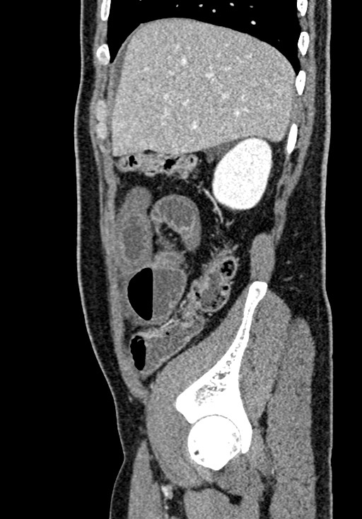 Adhesional small bowel obstruction (Radiopaedia 58900-66131 Sagittal C+ portal venous phase 57).jpg