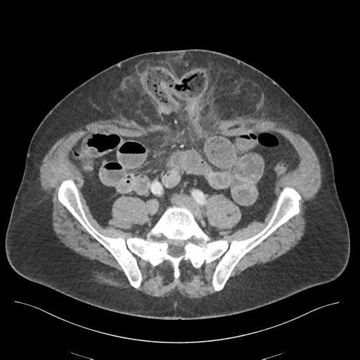 Adhesions within abdominal wall hernia (Radiopaedia 58283-65394 Axial C+ portal venous phase 58).png