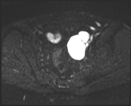 Adnexal multilocular cyst (O-RADS US 3- O-RADS MRI 3) (Radiopaedia 87426-103754 Axial DWI 12).jpg