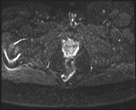 Adnexal multilocular cyst (O-RADS US 3- O-RADS MRI 3) (Radiopaedia 87426-103754 Axial DWI 23).jpg