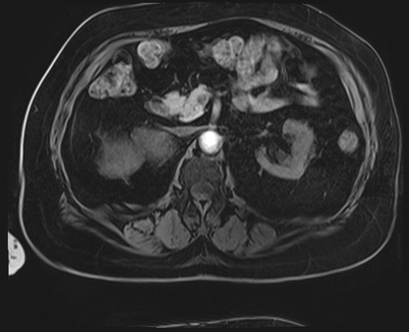 Adrenal cortical carcinoma (Radiopaedia 64017-72770 Axial T1 C+ fat sat 19).jpg