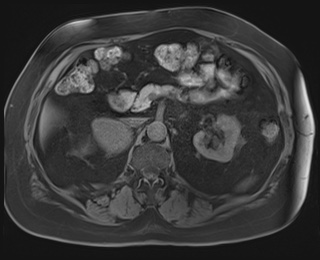 Adrenal cortical carcinoma (Radiopaedia 64017-72770 Axial T1 fat sat 36).jpg