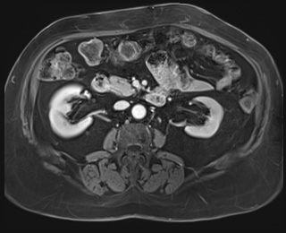 File:Adrenal cortical carcinoma (Radiopaedia 64017-72770 J 48).jpg