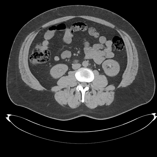 File:Adrenal cyst (Radiopaedia 45625-49778 Axial non-contrast 65).png