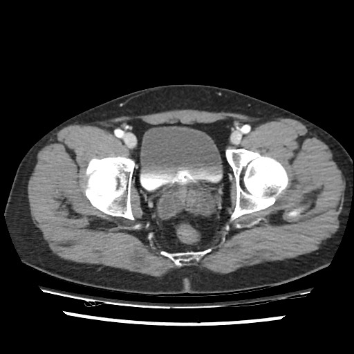 Adrenal gland trauma (Radiopaedia 81351-95078 Axial Dual bolus trauma C+ 115).jpg