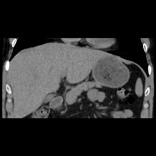 Adrenal gland trauma (Radiopaedia 81351-95079 Coronal non-contrast 36).jpg