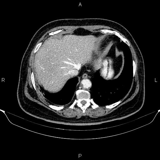 Adrenal hemorrhage (Radiopaedia 62622-70916 Axial C+ portal venous phase 17).jpg