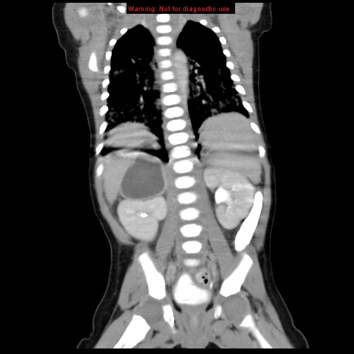 File:Adrenal hemorrhage (Radiopaedia 9390-10077 Coronal C+ portal venous phase 8).jpg