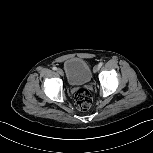 File:Adrenal lymphoma (Radiopaedia 73730-84529 Axial C+ portal venous phase 114).jpg